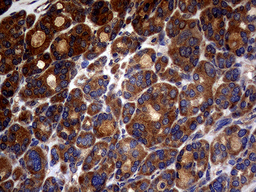 ATG16L1 / ATG16L Antibody - Immunohistochemical staining of paraffin-embedded Carcinoma of Human thyroid tissue using anti-ATG16L1 mouse monoclonal antibody. (Heat-induced epitope retrieval by 1mM EDTA in 10mM Tris buffer. (pH8.5) at 120°C for 3 min. (1:2000)
