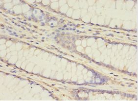 ATG16L1 / ATG16L Antibody - Immunohistochemistry of paraffin-embedded human colon cancer tissue using antibody at 1:100 dilution.  This image was taken for the unconjugated form of this product. Other forms have not been tested.