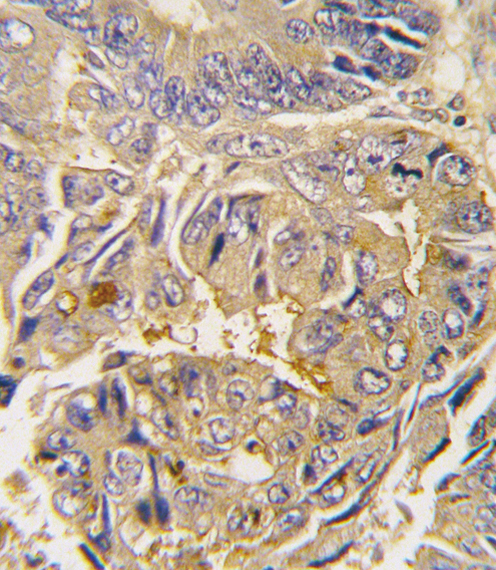 ATG16L1 / ATG16L Antibody - Formalin-fixed and paraffin-embedded human colon carcinoma tissue reacted with Autophagy APG16L antibody (L176), which was peroxidase-conjugated to the secondary antibody, followed by DAB staining. This data demonstrates the use of this antibody for immunohistochemistry; clinical relevance has not been evaluated.