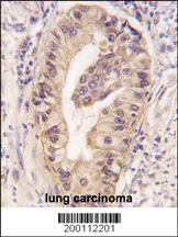 ATG16L1 / ATG16L Antibody - Formalin-fixed and paraffin-embedded human lung carcinoma tissue reacted with ATG16L1 Monoclonal Antibody , which was peroxidase-conjugated to the secondary antibody, followed by DAB staining. This data demonstrates the use of this antibody for immunohistochemistry; clinical relevance has not been evaluated.