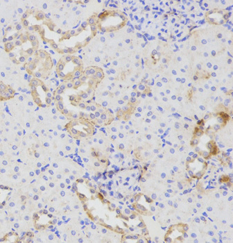 ATG16L1 / ATG16L Antibody - Immunohistochemistry of paraffin-embedded human colon cancer tissue.