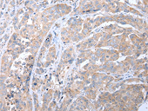 ATG16L1 / ATG16L Antibody - Immunohistochemistry of paraffin-embedded Human breast cancer tissue  using ATG16L1 Polyclonal Antibody at dilution of 1:40(×200)
