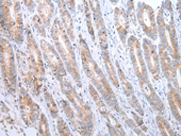 ATG16L1 / ATG16L Antibody - Immunohistochemistry of paraffin-embedded Human gastric cancer tissue  using ATG16L1 Polyclonal Antibody at dilution of 1:40(×200)
