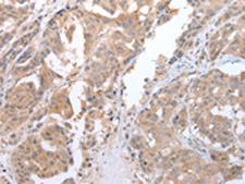 ATG16L1 / ATG16L Antibody - Immunohistochemistry of paraffin-embedded Human breast cancer tissue  using ATG16L1 Polyclonal Antibody at dilution of 1:45(×200)