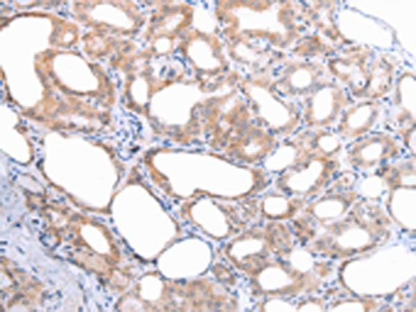 ATG16L1 / ATG16L Antibody - Immunohistochemistry of paraffin-embedded Human thyroid cancer tissue  using ATG16L1 Polyclonal Antibody at dilution of 1:45(×200)