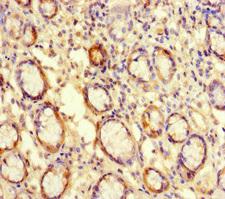 ATG16L2 Antibody - Immunohistochemistry of paraffin-embedded human gastric cancer at dilution of 1:100
