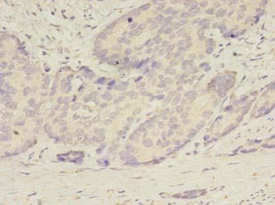 ATG2B Antibody - Immunohistochemistry of paraffin-embedded human gastric cancer using antibody at dilution of 1:100.