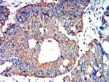 ATG3 Antibody - Immunohistochemical analysis of paraffin-embedded rectum cancer tissues using ATG3 mouse mAb with DAB staining.