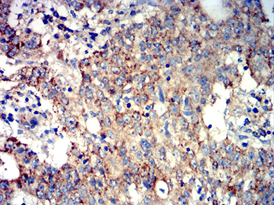 ATG3 Antibody - Immunohistochemical analysis of paraffin-embedded stomach cancer tissues using ATG3 mouse mAb with DAB staining.
