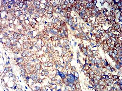 ATG3 Antibody - Immunohistochemical analysis of paraffin-embedded breast cancer tissues using ATG3 mouse mAb with DAB staining.