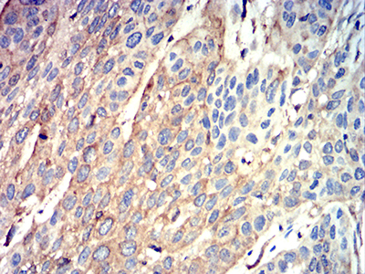 ATG3 Antibody - Immunohistochemical analysis of paraffin-embedded esophageal cancer tissues using ATG3 mouse mAb with DAB staining.