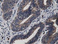 ATG3 Antibody - Immunohistochemical staining of paraffin-embedded Adenocarcinoma of Human endometrium tissue using anti-ATG3 mouse monoclonal antibody. (Heat-induced epitope retrieval by 10mM citric buffer, pH6.0, 100C for 10min,