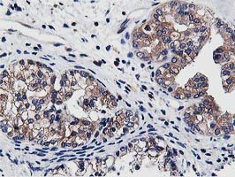 ATG3 Antibody - Immunohistochemical staining of paraffin-embedded Adenocarcinoma of Human ovary tissue using anti-ATG3 mouse monoclonal antibody. (Heat-induced epitope retrieval by 10mM citric buffer, pH6.0, 100C for 10min,
