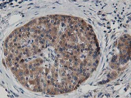 ATG3 Antibody - Immunohistochemical staining of paraffin-embedded Carcinoma of Human pancreas tissue using anti-ATG3 mouse monoclonal antibody. (Heat-induced epitope retrieval by 10mM citric buffer, pH6.0, 100C for 10min,