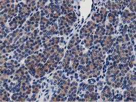ATG3 Antibody - Immunohistochemical staining of paraffin-embedded Carcinoma of Human thyroid tissue using anti-ATG3 mouse monoclonal antibody. (Heat-induced epitope retrieval by 10mM citric buffer, pH6.0, 100C for 10min,