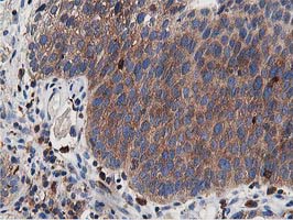 ATG3 Antibody - Immunohistochemical staining of paraffin-embedded Carcinoma of Human bladder tissue using anti-ATG3 mouse monoclonal antibody. (Heat-induced epitope retrieval by 10mM citric buffer, pH6.0, 100C for 10min,