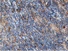 ATG3 Antibody - Immunohistochemical staining of paraffin-embedded Human lymphoma tissue using anti-ATG3 mouse monoclonal antibody. (Heat-induced epitope retrieval by 10mM citric buffer, pH6.0, 100C for 10min,
