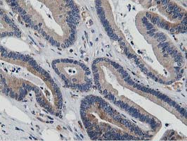 ATG3 Antibody - Immunohistochemical staining of paraffin-embedded Adenocarcinoma of Human colon tissue using anti-ATG3 mouse monoclonal antibody. (Heat-induced epitope retrieval by 10mM citric buffer, pH6.0, 100C for 10min,