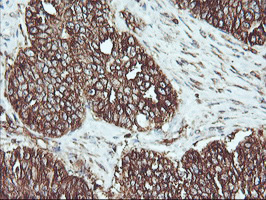 ATG3 Antibody - IHC of paraffin-embedded Adenocarcinoma of Human ovary tissue using anti-ATG3 mouse monoclonal antibody. (Heat-induced epitope retrieval by 10mM citric buffer, pH6.0, 100C for 10min).