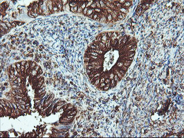 ATG3 Antibody - IHC of paraffin-embedded Adenocarcinoma of Human endometrium tissue using anti-ATG3 mouse monoclonal antibody. (Heat-induced epitope retrieval by 10mM citric buffer, pH6.0, 100C for 10min).