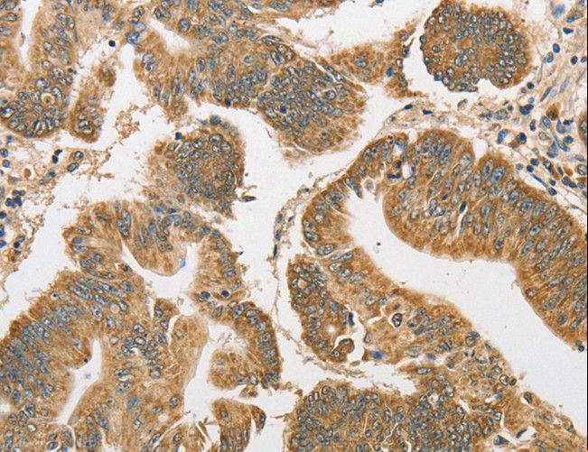 ATG3 Antibody - Immunohistochemistry of paraffin-embedded Human colon cancer using ATG3 Polyclonal Antibody at dilution of 1:40.