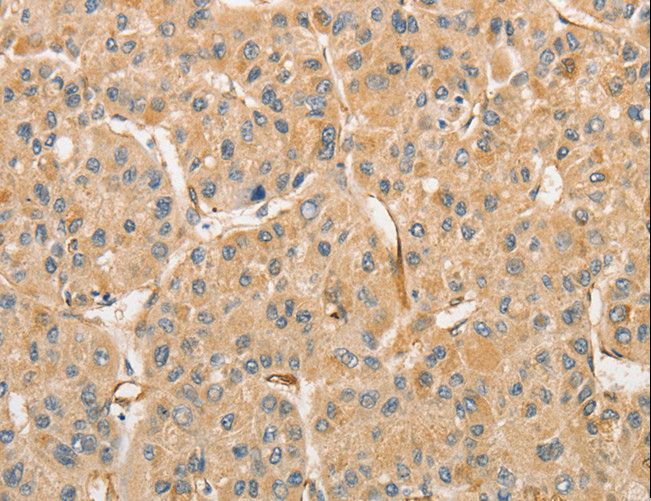 ATG3 Antibody - Immunohistochemistry of paraffin-embedded Human liver cancer using ATG3 Polyclonal Antibody at dilution of 1:30.