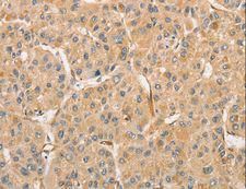 ATG3 Antibody - Immunohistochemistry of paraffin-embedded Human liver cancer using ATG3 Polyclonal Antibody at dilution of 1:30.