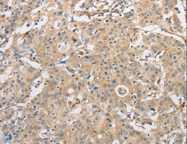 ATG3 Antibody - Immunohistochemistry of paraffin-embedded Human gastric cancer using ATG3 Polyclonal Antibody at dilution of 1:30.
