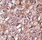 ATG4A Antibody - Formalin-fixed and paraffin-embedded human cancer tissue reacted with the primary antibody, which was peroxidase-conjugated to the secondary antibody, followed by AEC staining. This data demonstrates the use of this antibody for immunohistochemistry; clinical relevance has not been evaluated. BC = breast carcinoma; HC = hepatocarcinoma.