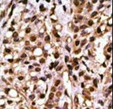 ATG4A Antibody - Formalin-fixed and paraffin-embedded human cancer tissue reacted with the primary antibody, which was peroxidase-conjugated to the secondary antibody, followed by DAB staining. This data demonstrates the use of this antibody for immunohistochemistry; clinical relevance has not been evaluated. BC = breast carcinoma; HC = hepatocarcinoma.