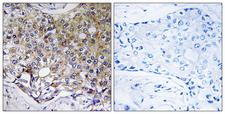 ATG4A Antibody - Peptide - + Immunohistochemistry analysis of paraffin-embedded human breast carcinoma tissue using ATG4A antibody.