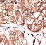 ATG4D Antibody - Formalin-fixed and paraffin-embedded human cancer tissue reacted with the primary antibody, which was peroxidase-conjugated to the secondary antibody, followed by AEC staining. This data demonstrates the use of this antibody for immunohistochemistry; clinical relevance has not been evaluated. BC = breast carcinoma; HC = hepatocarcinoma.