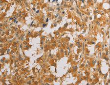 ATG4D Antibody - Immunohistochemistry of paraffin-embedded Human liver cancer using ATG4D Polyclonal Antibody at dilution of 1:40.