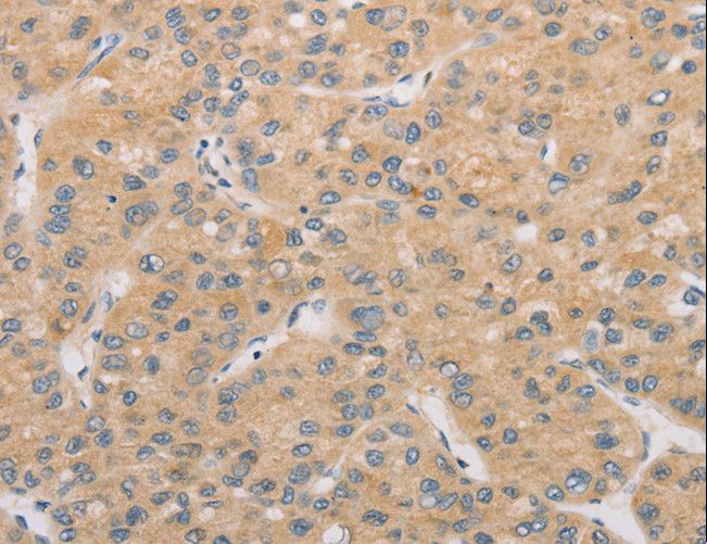 ATG4D Antibody - Immunohistochemistry of paraffin-embedded Human liver cancer using ATG4D Polyclonal Antibody at dilution of 1:40.