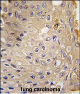 ATG9A Antibody - Formalin-fixed and paraffin-embedded human lung carcinoma tissue reacted with APG9L1 Antibody (S738) , which was peroxidase-conjugated to the secondary antibody, followed by DAB staining. This data demonstrates the use of this antibody for immunohistochemistry; clinical relevance has not been evaluated.