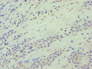 ATG9A Antibody - Immunohistochemistry of paraffin-embedded human breast cancer using antibody at 1:100 dilution.