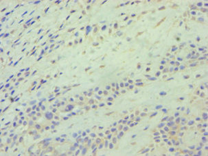 ATG9A Antibody - Immunohistochemistry of paraffin-embedded human breast cancer using ATG9A Antibody at dilution of 1:100