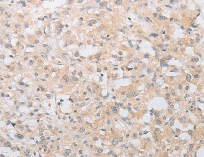 ATG9A Antibody - Immunohistochemistry of paraffin-embedded Human thyroid cancer using ATG9A Polyclonal Antibody at dilution of 1:30.