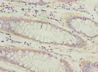 ATL2 Antibody - Immunohistochemistry of paraffin-embedded human colon cancer using antibody at dilution of 1:100.