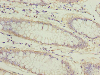 ATL2 Antibody - Immunohistochemistry of paraffin-embedded human colon cancer using ATL2 Antibody at dilution of 1:100