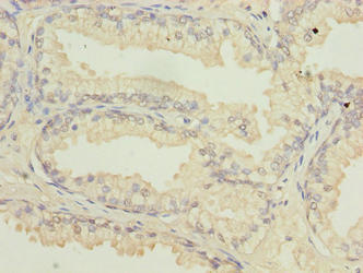 ATL2 Antibody - Immunohistochemistry of paraffin-embedded human prostate cancer using ATL2 Antibody at dilution of 1:100