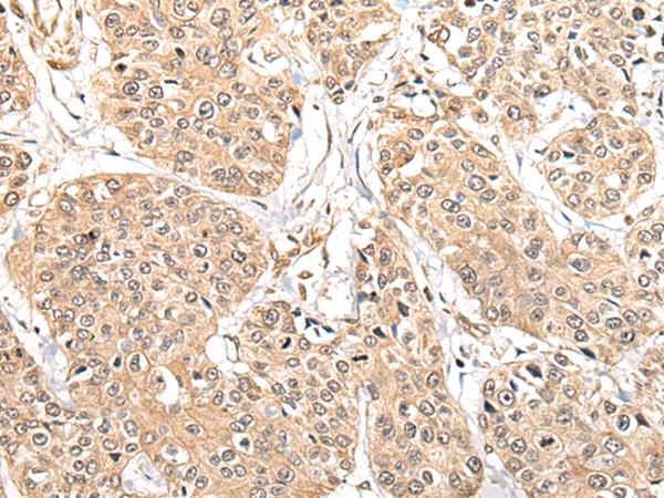 ATL3 Antibody - Immunohistochemistry of paraffin-embedded Human prost at e cancer tissue  using ATL3 Polyclonal Antibody at dilution of 1:85(×200)