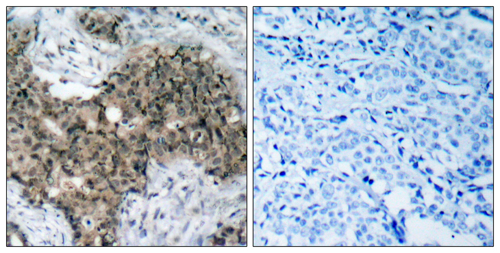 ATM Antibody - Immunohistochemistry analysis of paraffin-embedded human breast carcinoma tissue, using ATM Antibody. The picture on the right is blocked with the synthesized peptide.