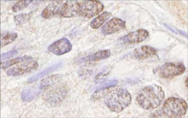 ATM Antibody - Detection of Human ATM by Immunohistochemistry. Sample: FFPE section of human prostate (nodular hypertrophy). Antibody: Affinity purified rabbit anti-ATM used at a dilution of 1:250. Detection: DAB.