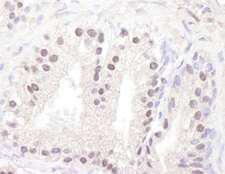 ATM Antibody - Detection of Human ATM by Immunohistochemistry. Sample: FFPE section of human prostate-nodular hypertrophy. Antibody: Affinity purified rabbit anti-ATM used at a dilution of 1:1000 (1 ug/ml).