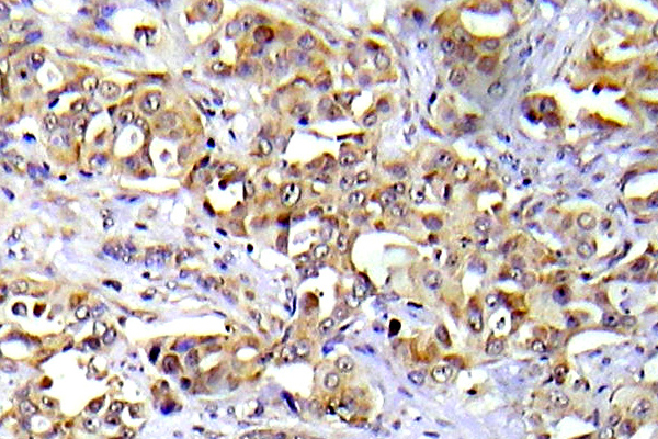 ATM Antibody - IHC of ATM (I1987)pAb in paraffin-embedded human lung adenocarcinoma tissue.