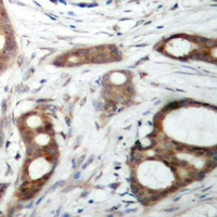 ATM Antibody - Immunohistochemical analysis of ATM staining in human prostate cancer formalin fixed paraffin embedded tissue section. The section was pre-treated using heat mediated antigen retrieval with sodium citrate buffer (pH 6.0). The section was then incubated with the antibody at room temperature and detected using an HRP polymer system. DAB was used as the chromogen. The section was then counterstained with hematoxylin and mounted with DPX.