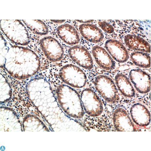 ATM Antibody - Immunohistochemistry (IHC) analysis of paraffin-embedded Human Breast Carcinoma Tissue using ATM Mouse Monoclonal Antibody diluted at 1:200.