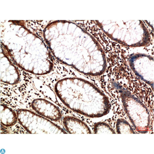 ATM Antibody - Immunohistochemistry (IHC) analysis of paraffin-embedded Human Colon Carcinoma Tissue using ATM Mouse Monoclonal Antibody diluted at 1:200.