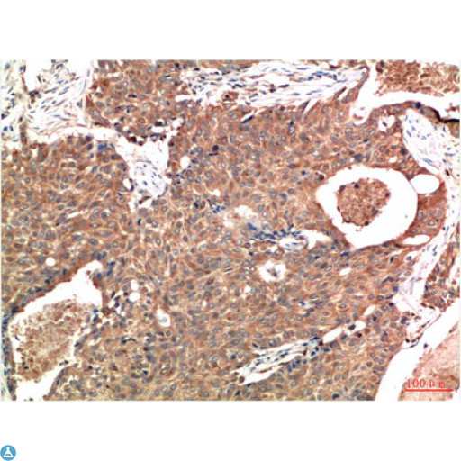 ATM Antibody - Immunohistochemistry (IHC) analysis of paraffin-embedded Human Breast Carcinoma Tissue using ATM Mouse Monoclonal Antibody diluted at 1:200.